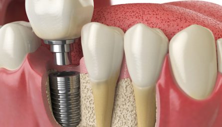 dental-implants_highland